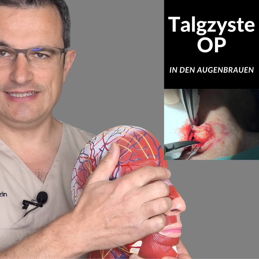 Talgzyste in den Augenbrauen entfernen Talgzyste in den Augenbrauen entfernen